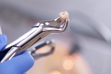 How to Prepare for a Tooth Extraction